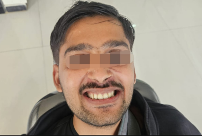 After Whitening