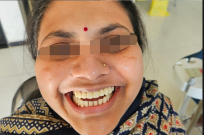After Whitening