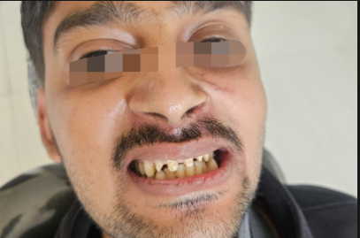 Before Whitening
