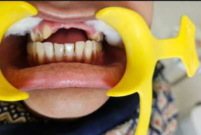 Before Whitening