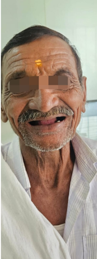 Before Whitening
